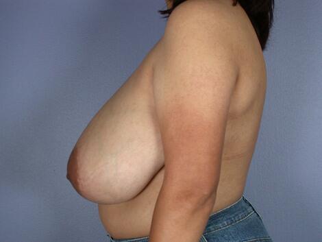 Breast Reduction (for Women) Before & After Image