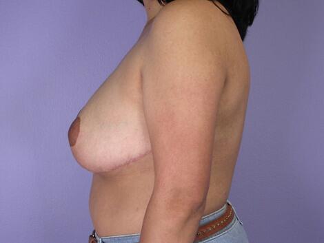 Breast Reduction (for Women) Before & After Image