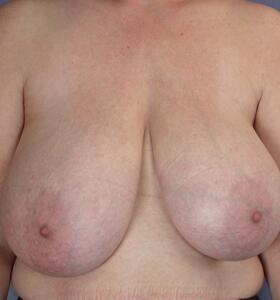 Breast Reduction (for Women) Before & After Image