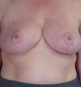 Breast Reduction (for Women) Before & After Image