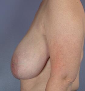 Breast Reduction (for Women) Before & After Image