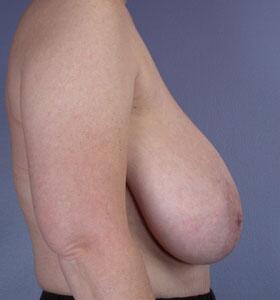 Breast Reduction (for Women) Before & After Image