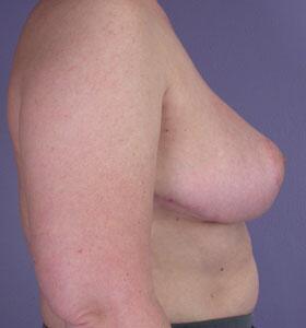 Breast Reduction (for Women) Before & After Image