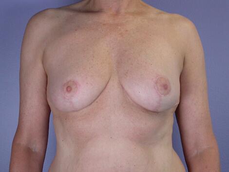 Breast Reduction (for Women) Before & After Image