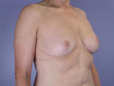 Breast Reduction (for Women) Before & After Image