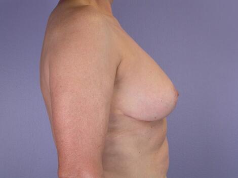 Breast Reduction (for Women) Before & After Image