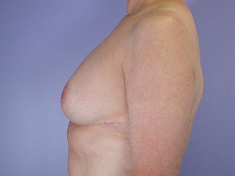 Breast Reduction (for Women) Before & After Image