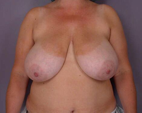 Breast Reduction (for Women) Before & After Image