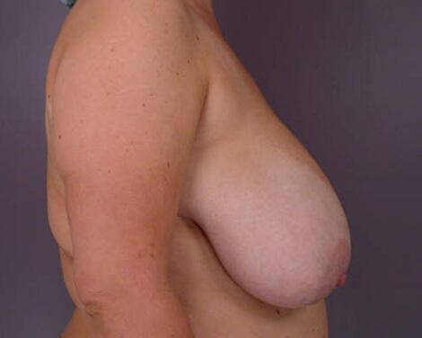 Breast Reduction (for Women) Before & After Image