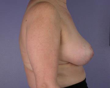 Breast Reduction (for Women) Before & After Image