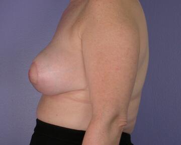 Breast Reduction (for Women) Before & After Image