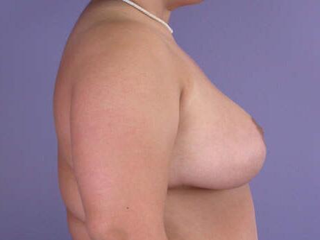 Breast Reduction (for Women) Before & After Image