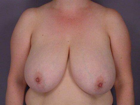 Breast Reduction (for Women) Before & After Image