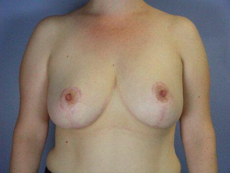 Breast Reduction (for Women) Before & After Image