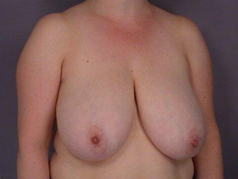 Breast Reduction (for Women) Before & After Image