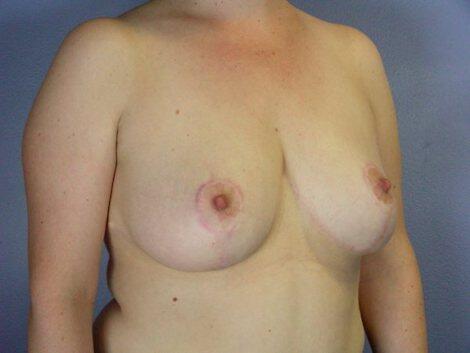 Breast Reduction (for Women) Before & After Image