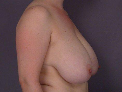 Breast Reduction (for Women) Before & After Image