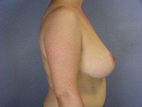 Breast Reduction (for Women) Before & After Image