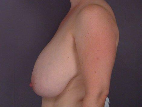 Breast Reduction (for Women) Before & After Image