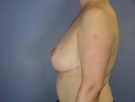 Breast Reduction (for Women) Before & After Image