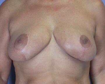 Breast Reduction (for Women) Before & After Image