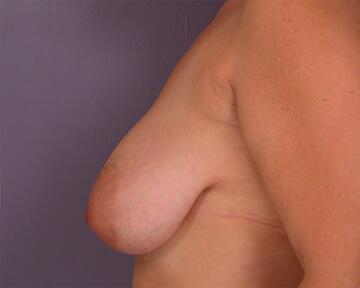 Breast Reduction (for Women) Before & After Image