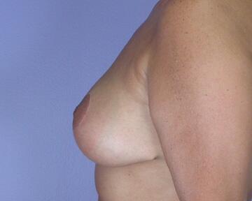 Breast Reduction (for Women) Before & After Image