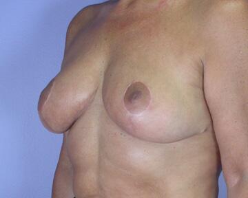 Breast Reduction (for Women) Before & After Image