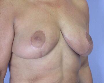 Breast Reduction (for Women) Before & After Image