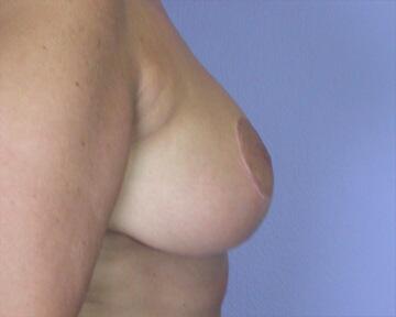 Breast Reduction (for Women) Before & After Image