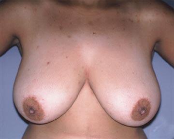 Breast Reduction (for Women) Before & After Image