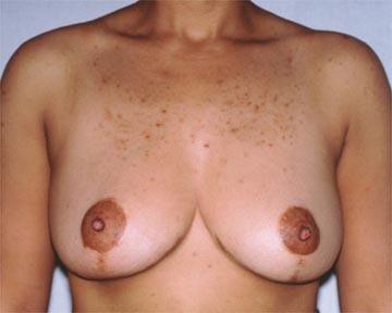 Breast Reduction (for Women) Before & After Image