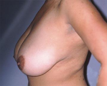 Breast Reduction (for Women) Before & After Image