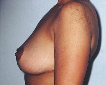 Breast Reduction (for Women) Before & After Image