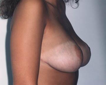 Breast Reduction (for Women) Before & After Image