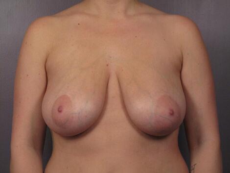 Breast Reduction (for Women) Before & After Image