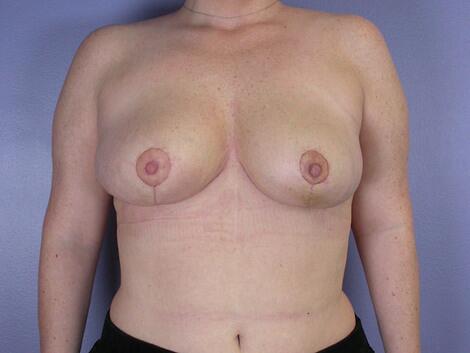 Breast Reduction (for Women) Before & After Image