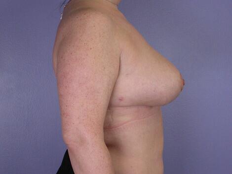 Breast Reduction (for Women) Before & After Image