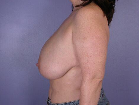 Breast Reduction (for Women) Before & After Image