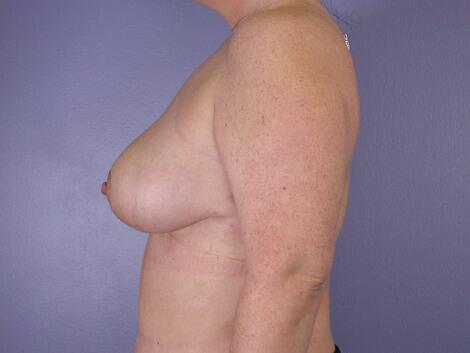 Breast Reduction (for Women) Before & After Image