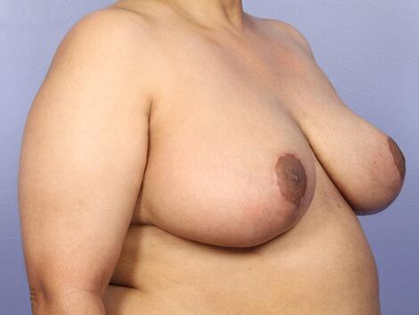 Breast Reduction (for Women) Before & After Image