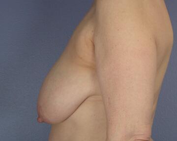 Breast Reduction (for Women) Before & After Image