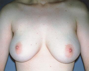 Breast Reduction (for Women) Before & After Image