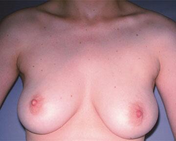 Breast Reduction (for Women) Before & After Image