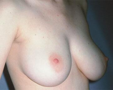 Breast Reduction (for Women) Before & After Image