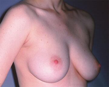 Breast Reduction (for Women) Before & After Image