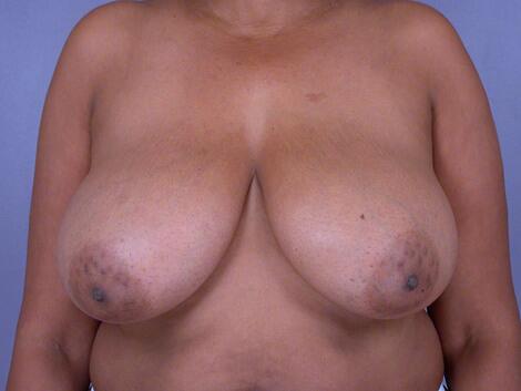 Breast Reduction (for Women) Before & After Image