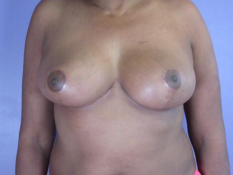 Breast Reduction (for Women) Before & After Image