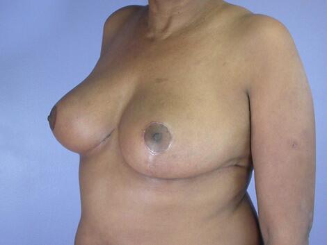 Breast Reduction (for Women) Before & After Image