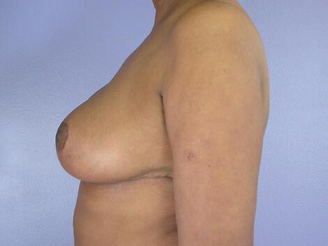 Breast Reduction (for Women) Before & After Image